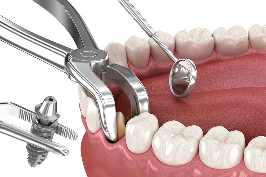 Unlocking Benefits of Immediate Dental Implant
